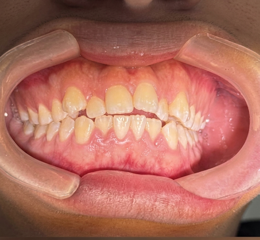 Antes: dientes apiñados y desalineados