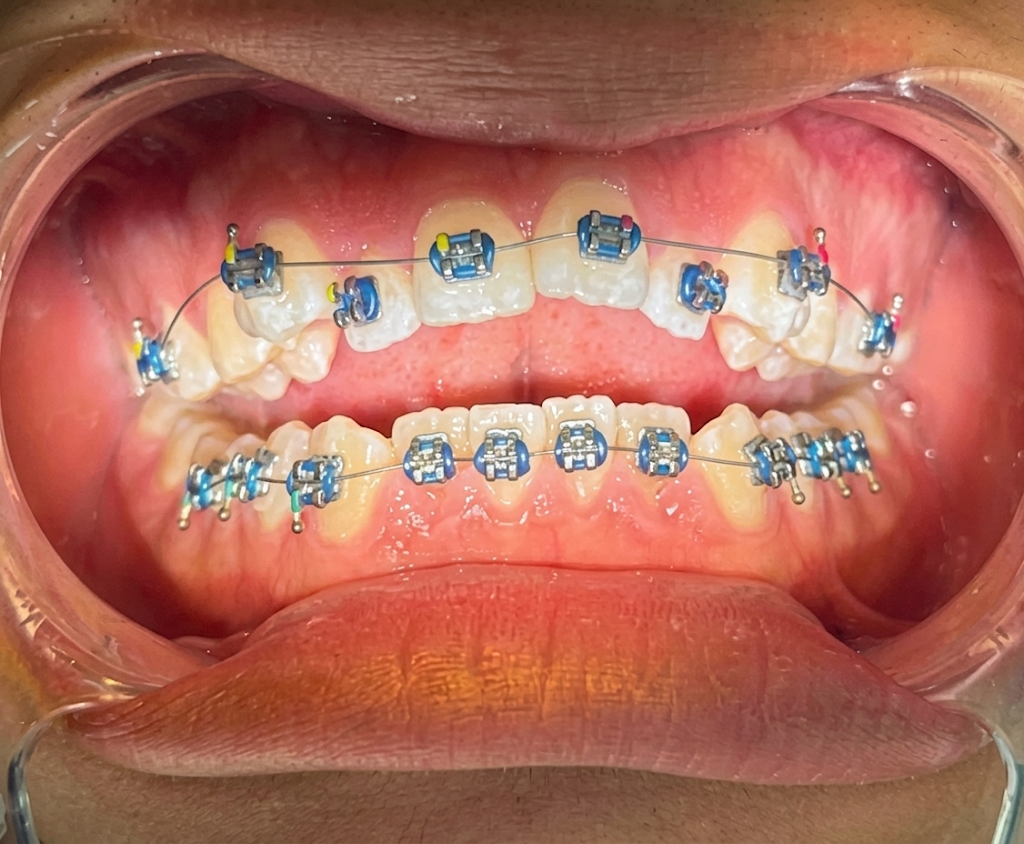 Después: dientes alineados con brackets en tratamiento activo