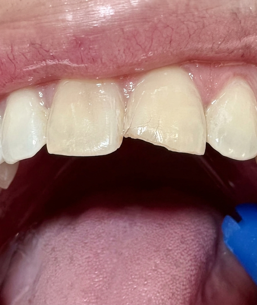 Antes: diente anterior fracturado