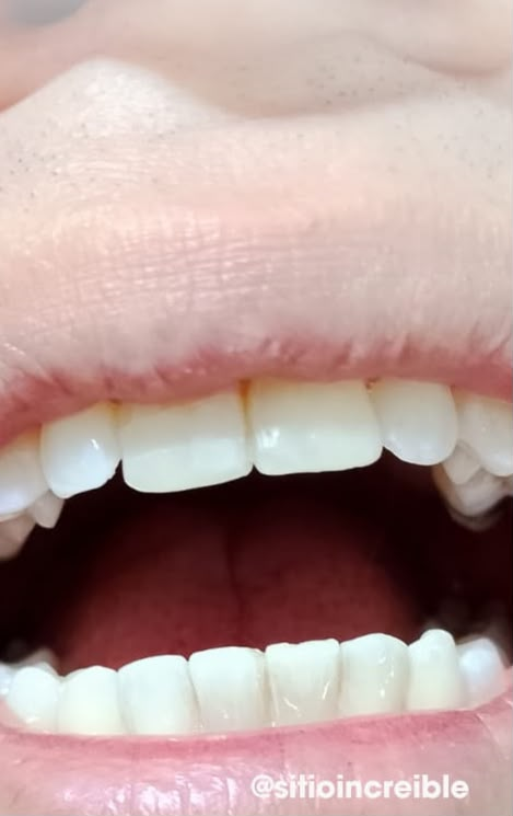 Después: sonrisa restaurada con estética natural