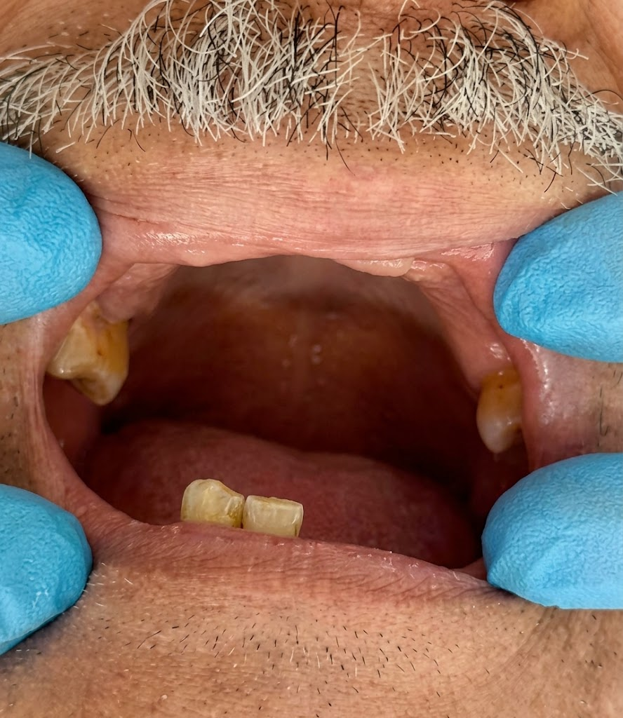 Antes: pérdida dental avanzada