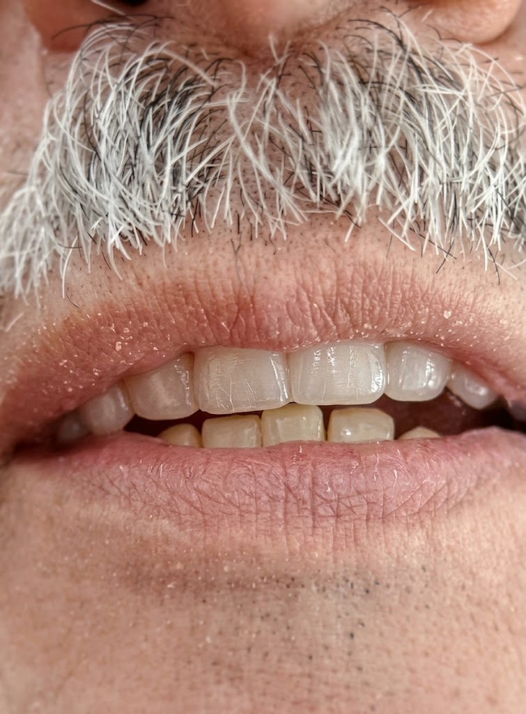 Después: rehabilitación oral finalizada